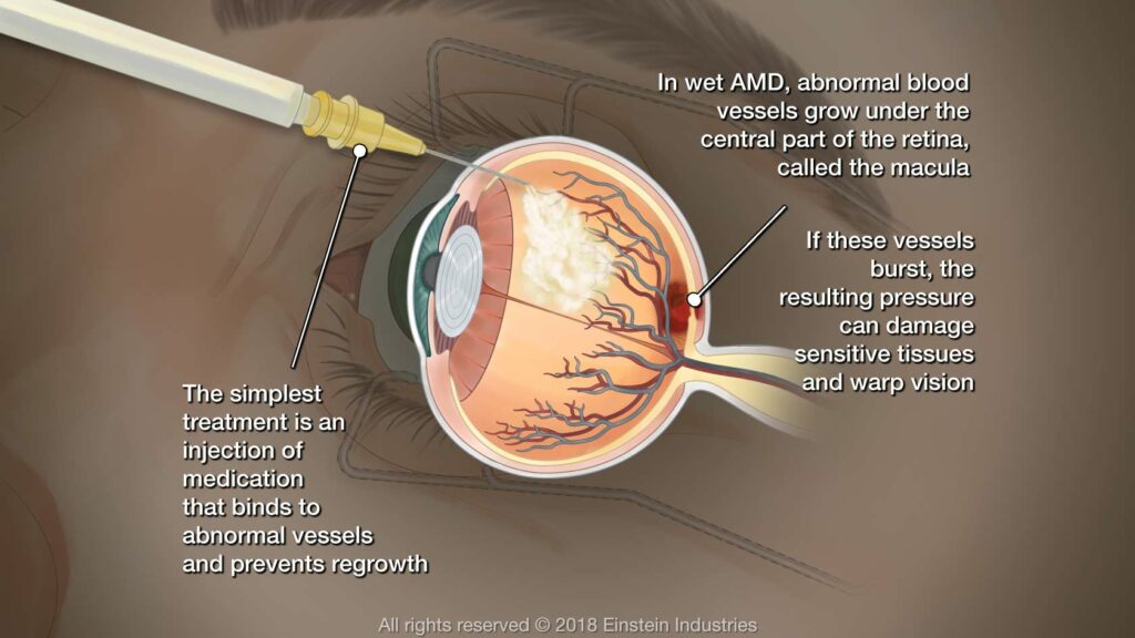 Causes and Treatment of Macular Degeneration