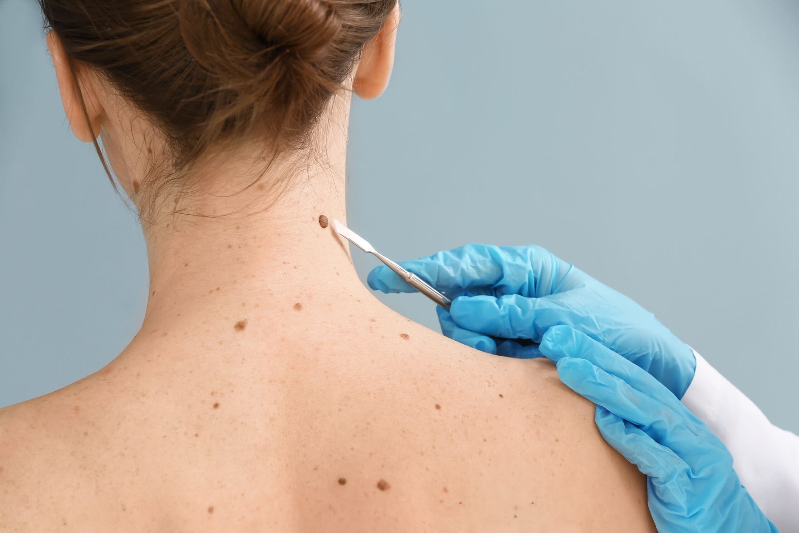 How Consulting a Melanoma Dermatologist Helps With Skin Health
