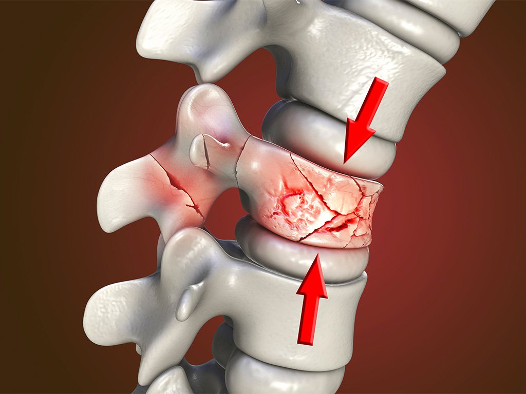 Symptoms of a Spine Fracture