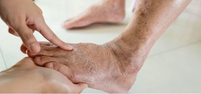 The Role of a Vascular Specialist in Managing Chronic Venous Insufficiency