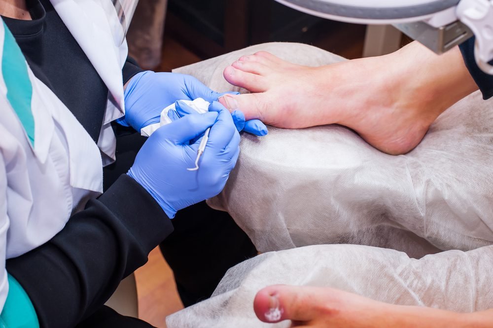 Tips for Ingrown Toenail Care to Prevent Infection
