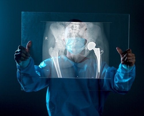 What Patients Should Know About Joint Replacement