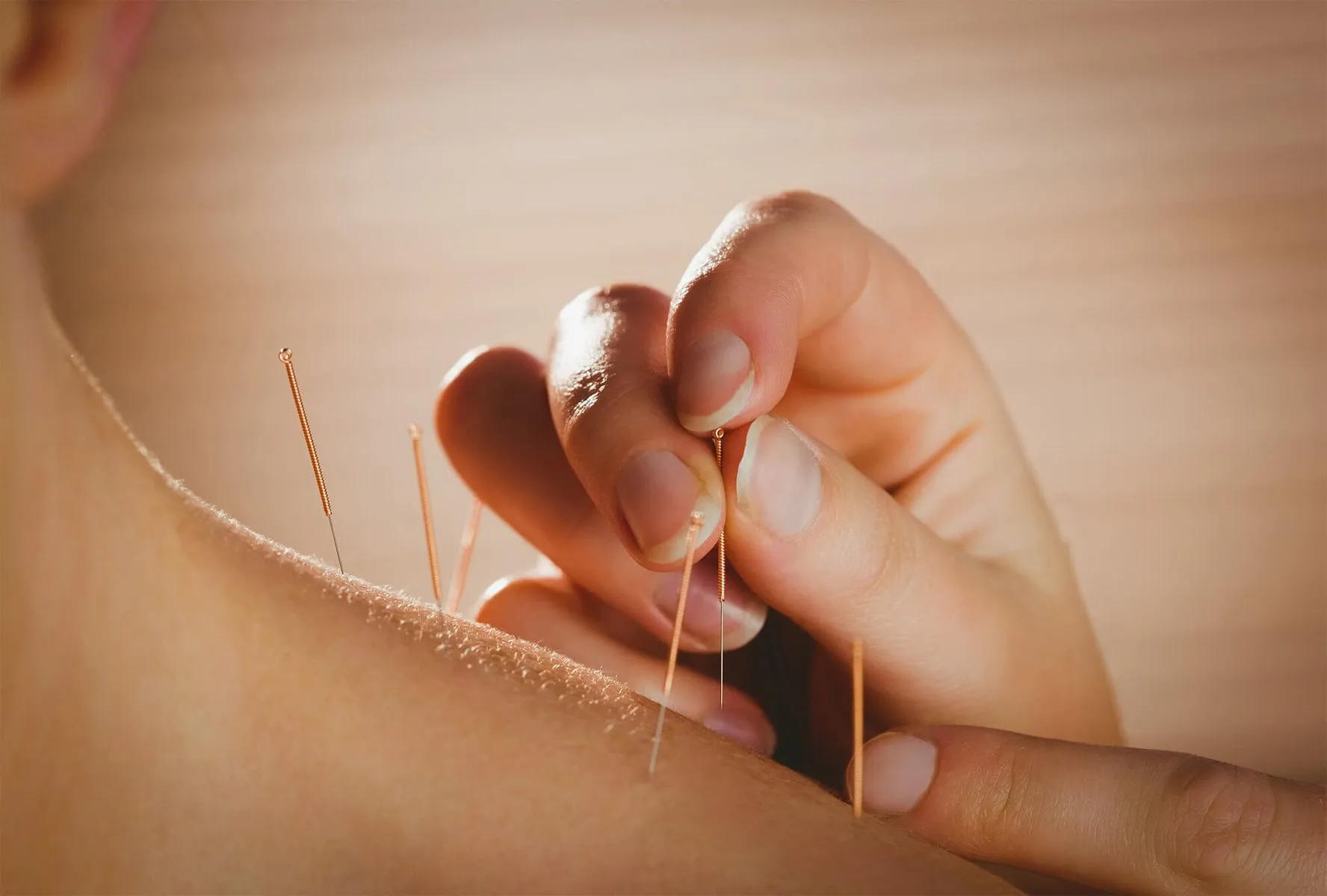 When To Try Acupuncture as a Complementary Therapy