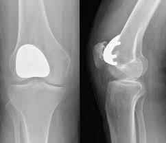 Understanding the Rehabilitation Process After Joint Replacement