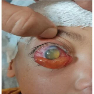 Causes and Risk Factors of Retinal Detachment