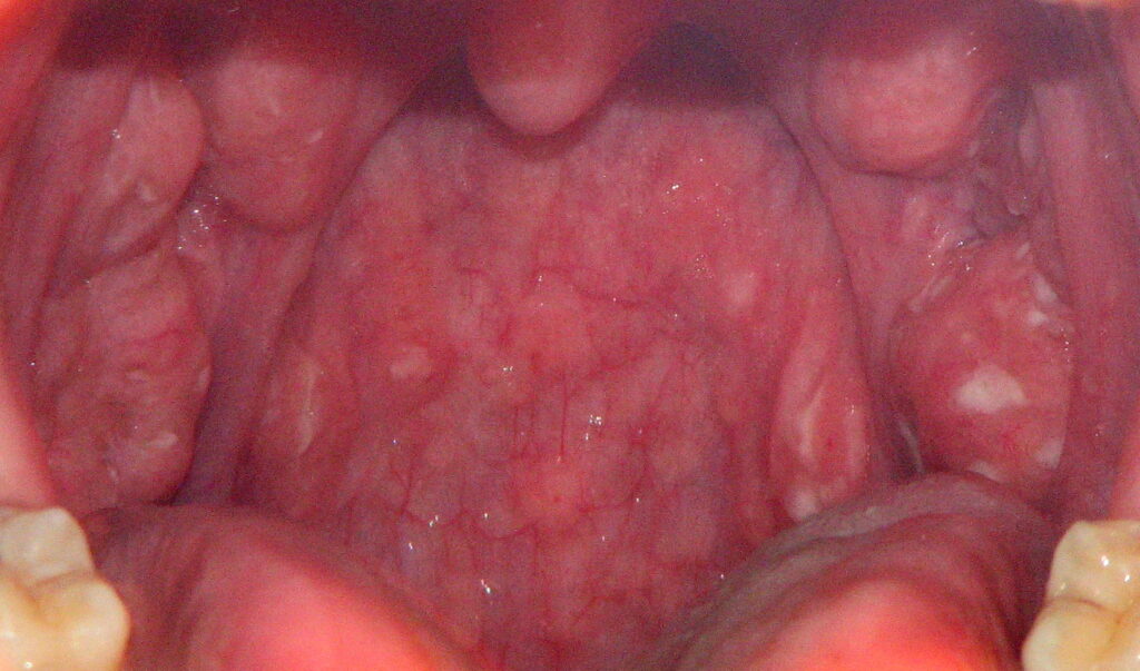 Common Strep Throat Symptoms To Watch For