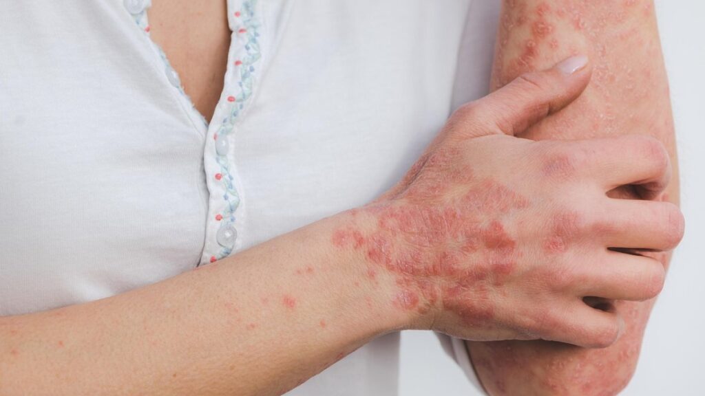 Recognizing Chronic Hives and When to Seek Professional Help