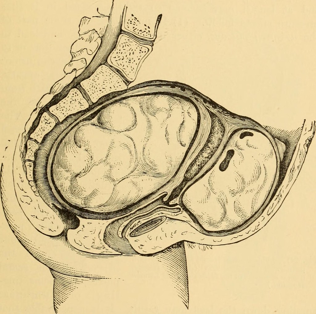 What You Need To Know About Fibroid Symptoms and Treatment