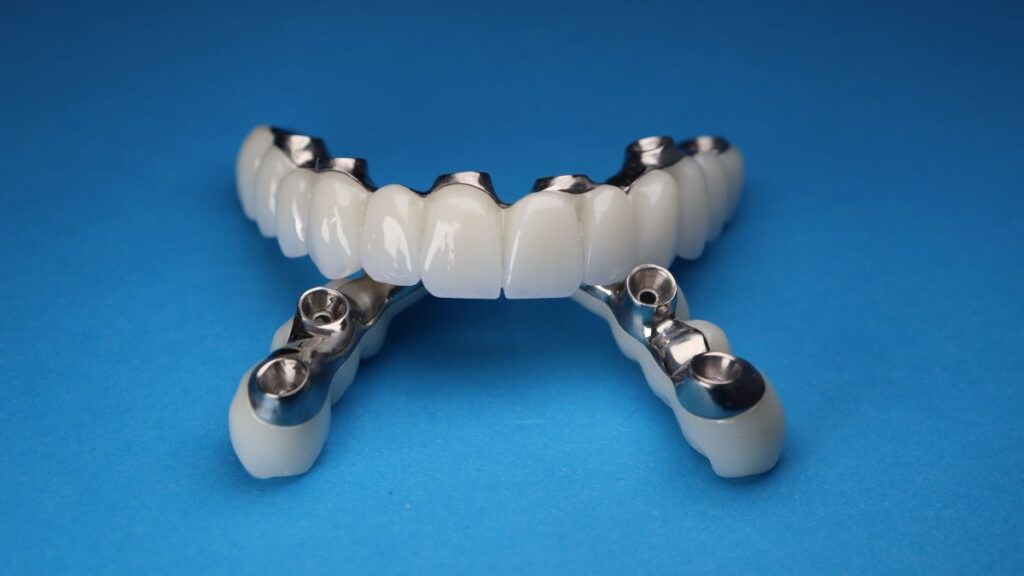 When Are All-on-6 Restorations Needed?