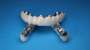 When Are All-on-6 Restorations Needed?